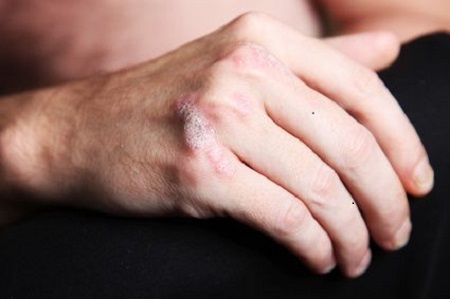 psoriasis - schuppenflechte an der Hand - nahaufnahme